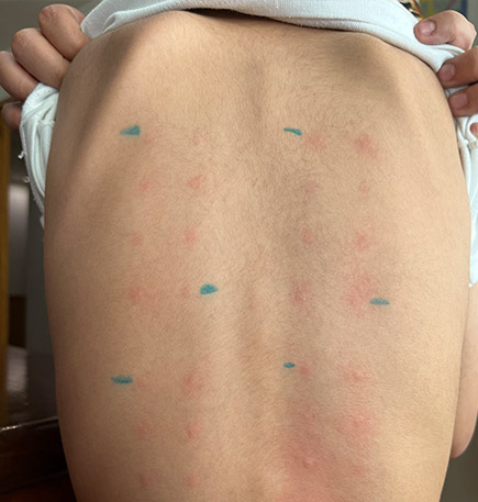 Dra Nancy Cruz alergia