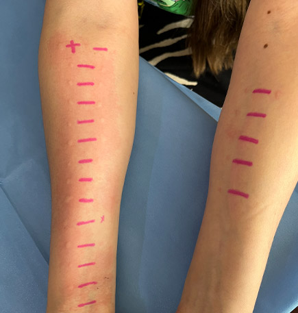 Dra Nancy Cruz alergia