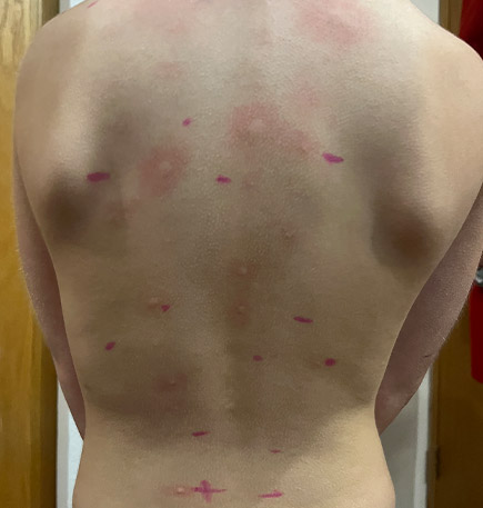 Dra Nancy Cruz alergia